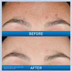 CERAVE ACNE RESURFACING SERUM 1OZ